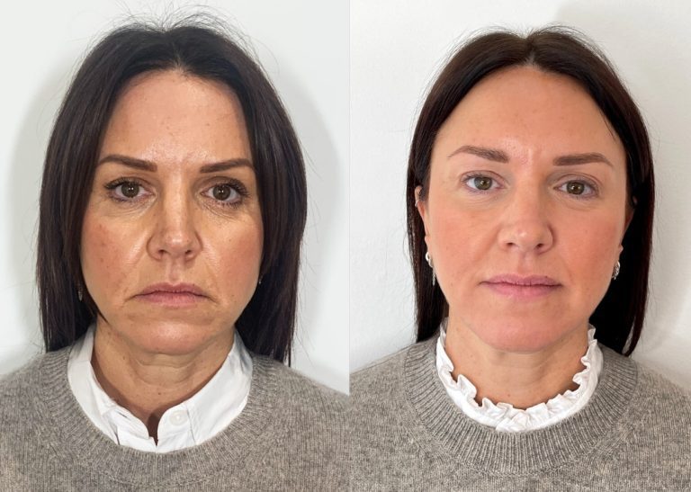 Before and after aesthetic treatment result